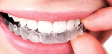Элайнеры Invisalign