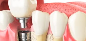 Implant prosthetics in the absence of 1 tooth