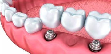 Implant prosthetics in the absence of several teeth (bridge)