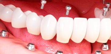 Implant prosthetics in the absence of the entire dentition