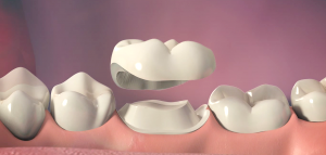Temporary prosthetics