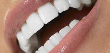 Veneers